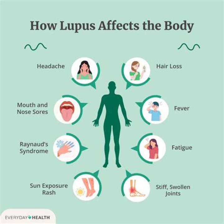 Can lupus cause hot flashes?