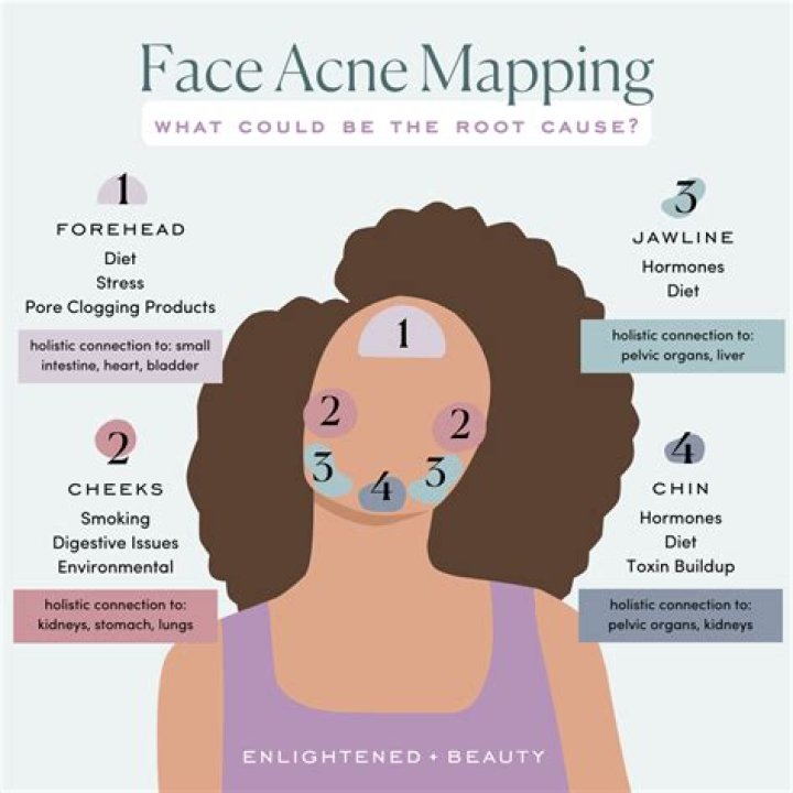 Does falling in love cause acne?