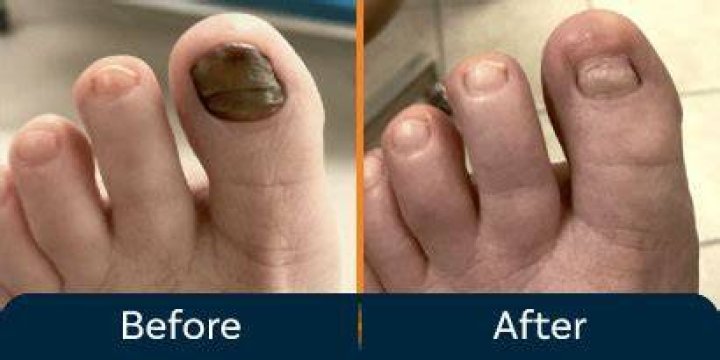 How long will my toe hurt after toenail removal?