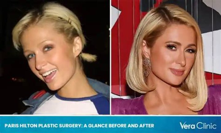 The Ultimate Guide To Paris Hilton's Plastic Surgery Journey