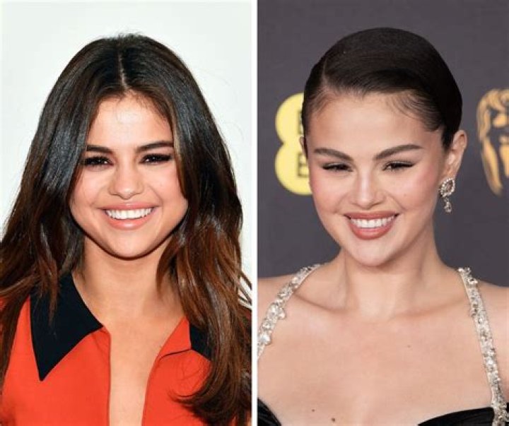 Uncovering The Truth: Did Selena Gomez Undergo Vocal Surgery?
