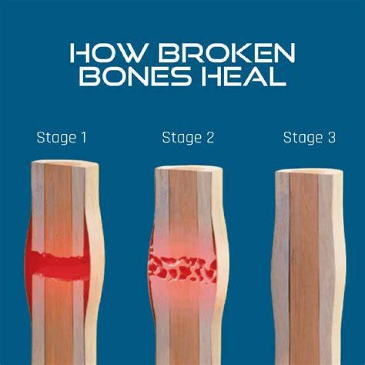 What does it feel like when a bone is healing?